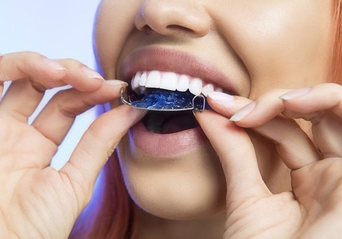 invisalign-procedure-retainer