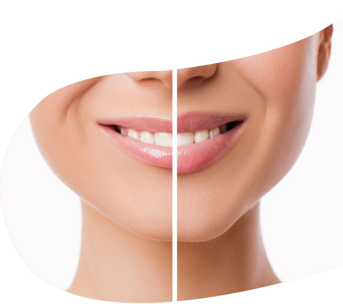 Fillers