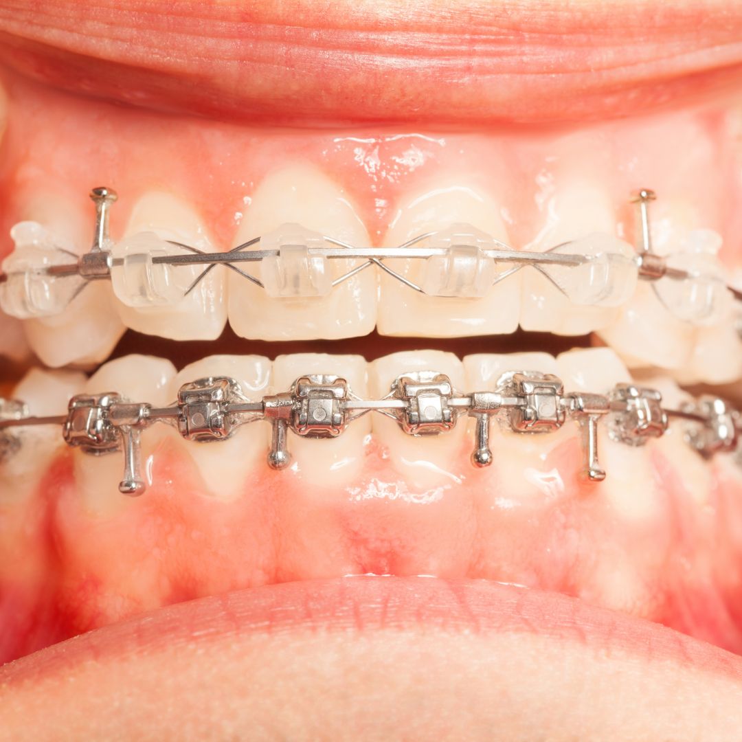 4 Benefits Of Getting Braces As A Kid | Okuda & Noorda Orthodontics