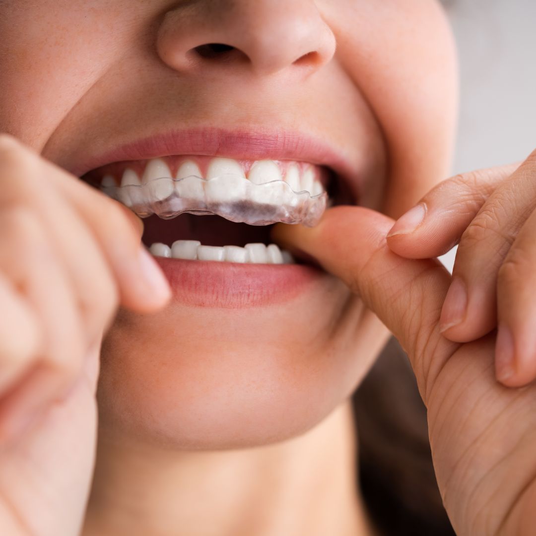 woman putting Invisalign in