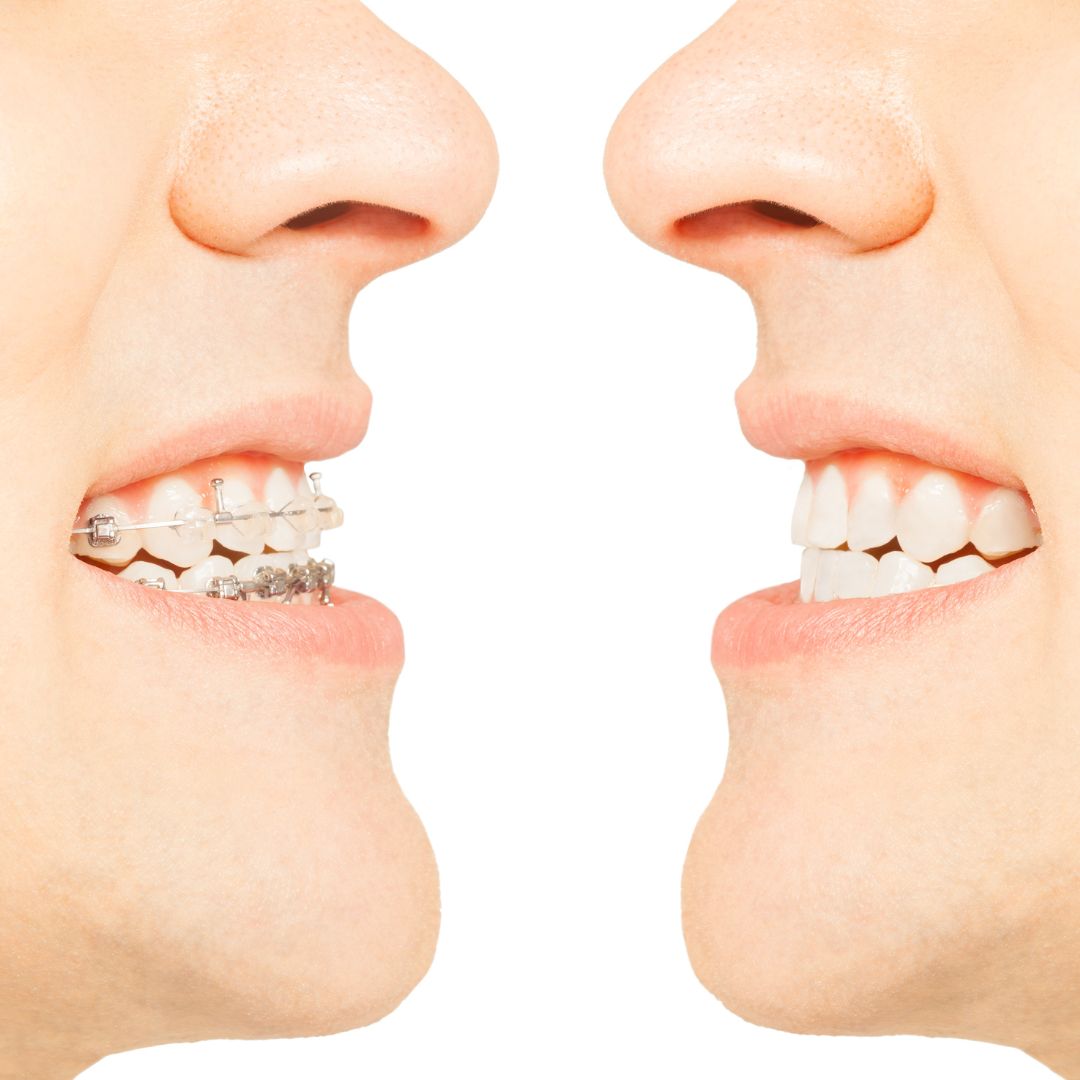 traditional braces vs Invisalign