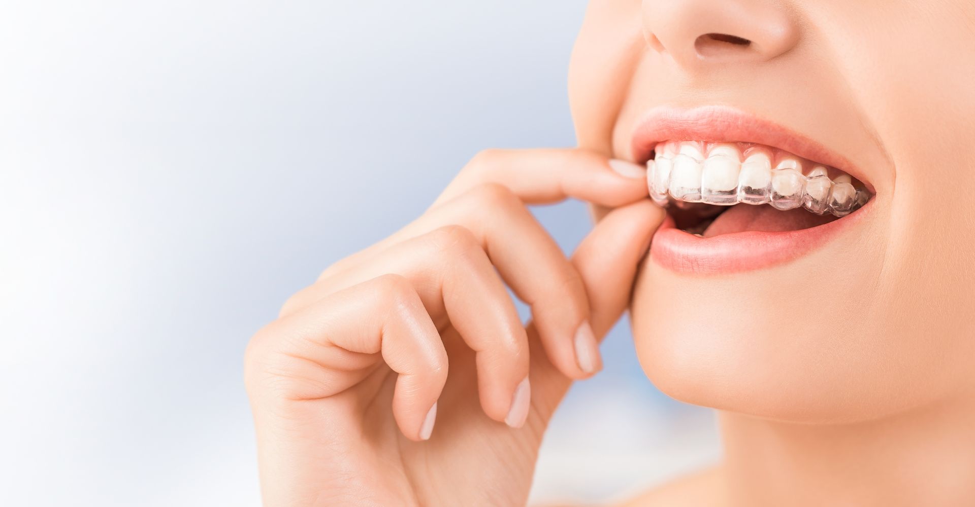 4 Reasons to Choose Invisalign® for Straighter Teeth