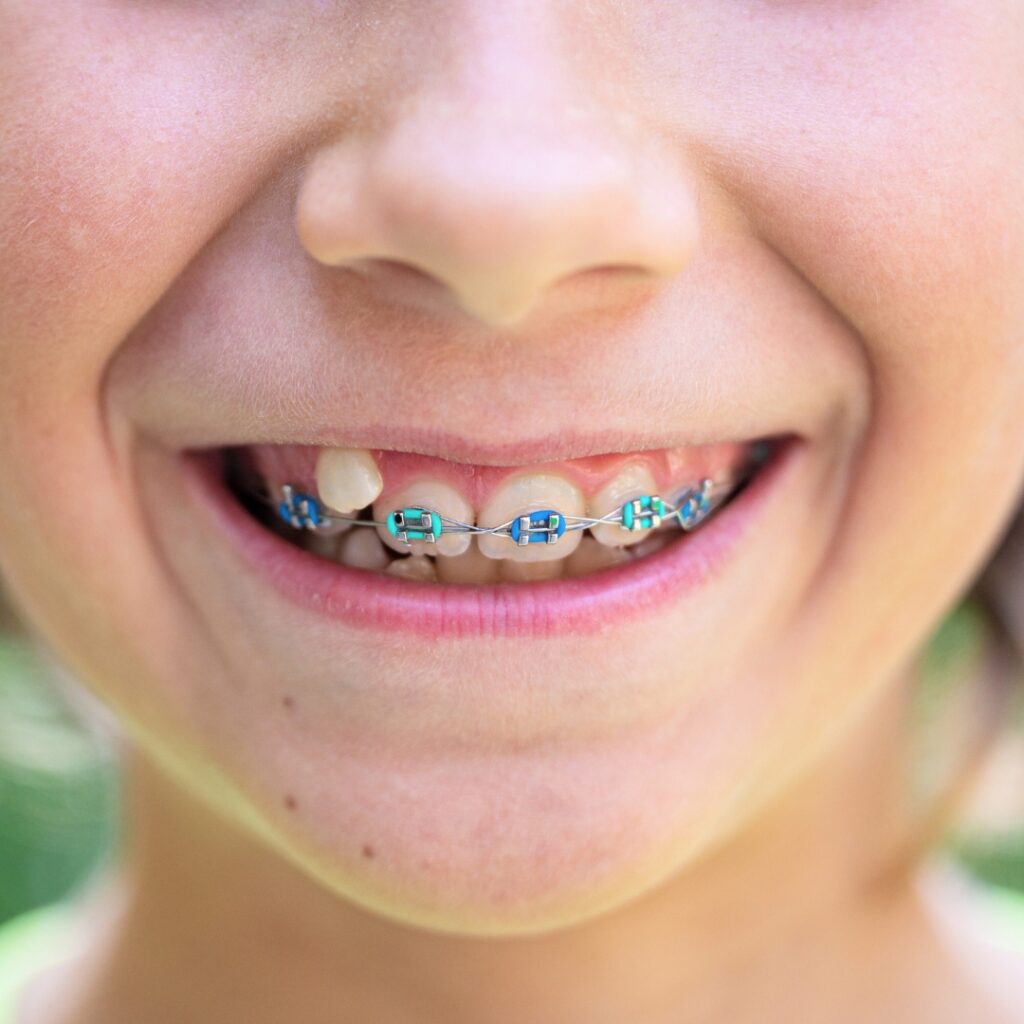 Interceptive Orthodontic Treatment The Benefits Of Early Intervention