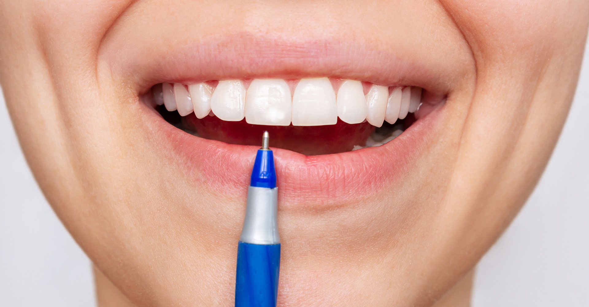 How to Avoid White Spots After Braces