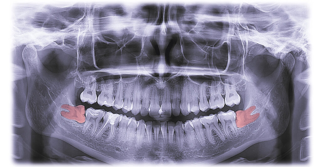 wisdom tooth